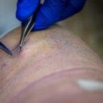 Comprendre le saignement d'implantation et sa durée découvrez tout ce qu'il faut savoir sur le saignement post-implantation : causes, symptômes et conseils pour gérer cette situation. informez-vous sur les implications et les meilleures pratiques à suivre pour assurer votre santé et votre bien-être après une implantation.